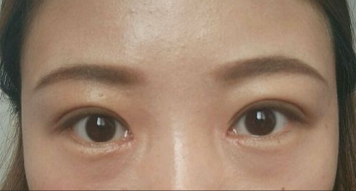 全切雙眼皮能保持多久？