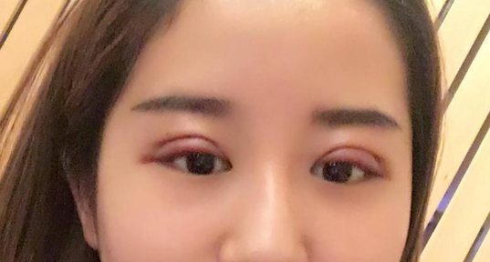 全切雙眼皮好不好？全切雙眼皮多長時間恢復自然？