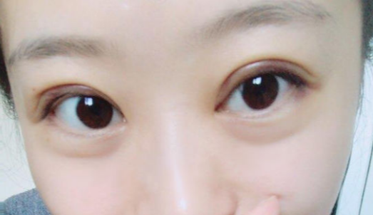 全切雙眼皮手術(shù)時間？全切雙眼皮術(shù)后會反彈嗎？