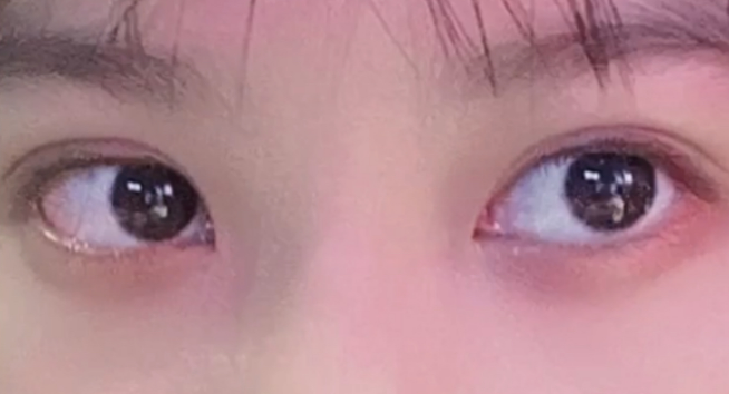 全切雙眼皮有哪些壞處？
