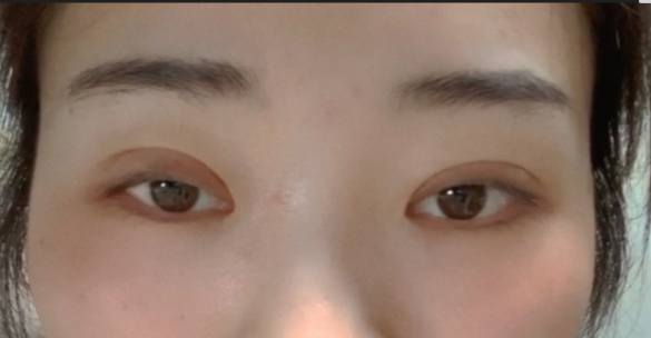 什么是全切雙眼皮？