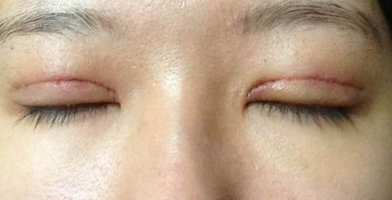 全切雙眼皮到底疼不疼？