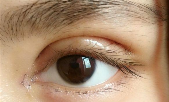 全切雙眼皮會(huì)留疤嗎？