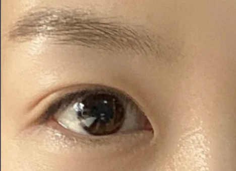 全切雙眼皮效果怎么樣？全切雙眼皮多久自然？