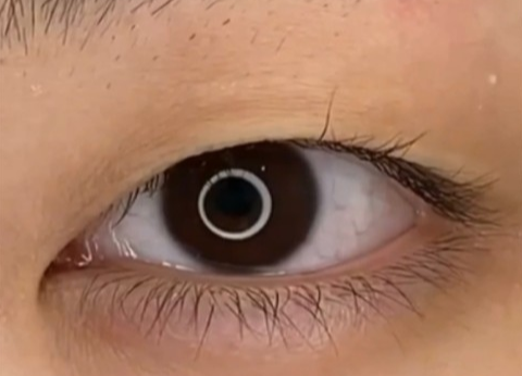 全切雙眼皮疤痕多久能消失？全切雙眼皮幾天可以洗臉？