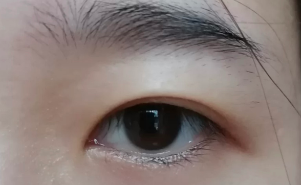 雙眼皮全切好還是韓式三點(diǎn)微創(chuàng)好？