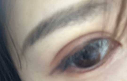 埋線雙眼皮手術(shù)優(yōu)勢(shì)有哪些？