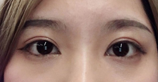 埋線雙眼皮幾天可以碰水？