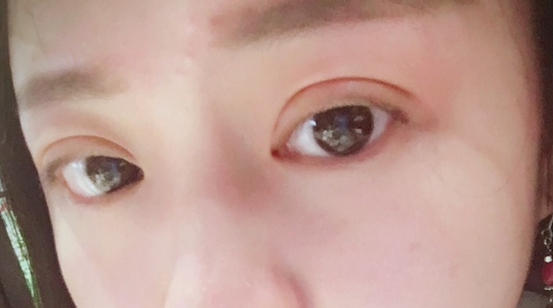 埋線雙眼皮可以保持幾年？埋線雙眼皮的危害有哪些？