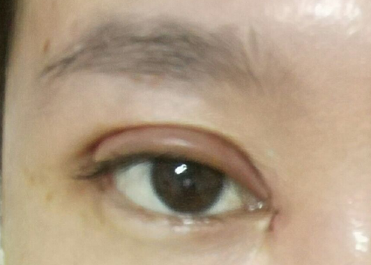 埋線雙眼皮可以維持幾年？