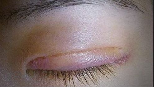 埋線雙眼皮一般會(huì)腫幾天？雙眼皮埋線好還是切開(kāi)好？