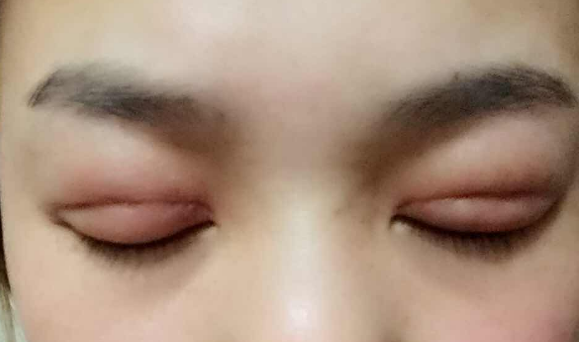 埋線雙眼皮幾天能消腫？