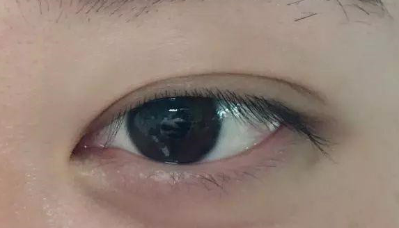 埋線雙眼皮有沒(méi)有危害？