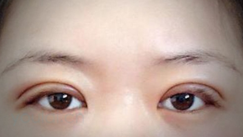 定點(diǎn)雙眼皮幾天能恢復(fù)好？定點(diǎn)做雙眼皮多少錢？