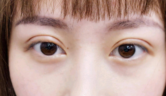 定點(diǎn)雙眼皮是什么意思？雙眼皮定點(diǎn)能維持多久？