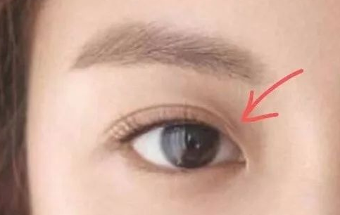 定點(diǎn)雙眼皮一般多少錢(qián)？