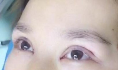 定點(diǎn)雙眼皮手術(shù)效果自然嗎？定點(diǎn)雙眼皮失敗怎么修復(fù)？