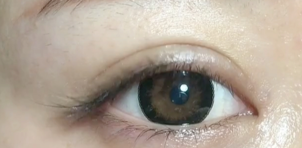 什么是雙眼皮定點？定點雙眼皮多久恢復(fù)？