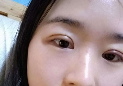 割雙眼皮后要冰敷多久？割雙眼皮后眼睛會(huì)變大嗎？