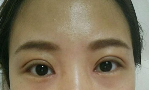定點(diǎn)雙眼皮會腫嗎？定點(diǎn)雙眼皮會有疤痕嗎？