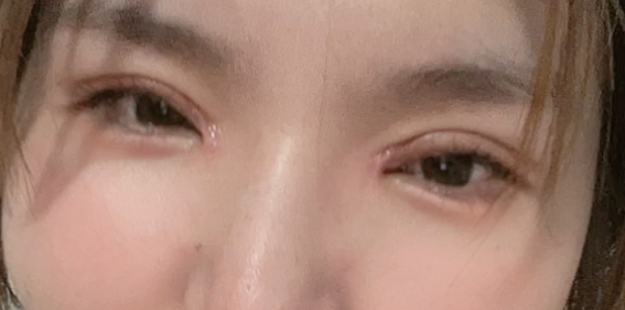 割雙眼皮后要冰敷多久？