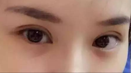做雙眼皮對(duì)身體有沒(méi)有危害？
