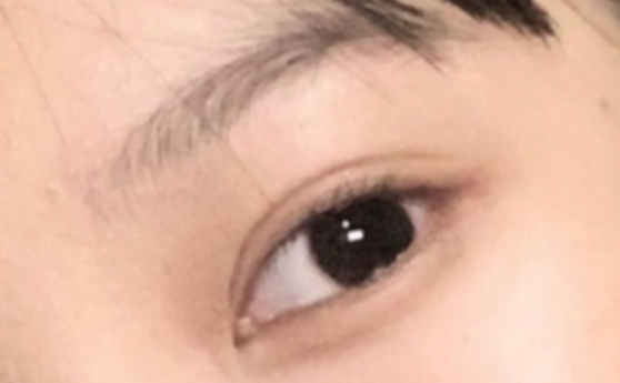做雙眼皮效果能保持多久？做雙眼皮要冰敷多久？
