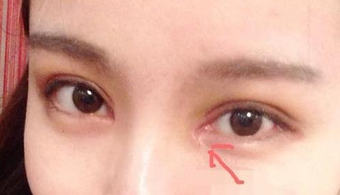 單眼皮開內(nèi)眼角會(huì)留疤嗎？