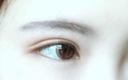 開眼角的恢復(fù)期多長？開眼角的后遺癥都有什么？