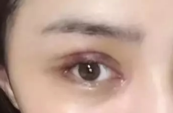 韓式開眼角失敗了怎么辦？