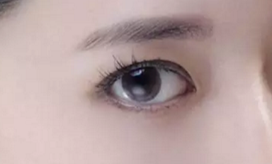 韓式開眼角的手術(shù)費(fèi)用是多少？