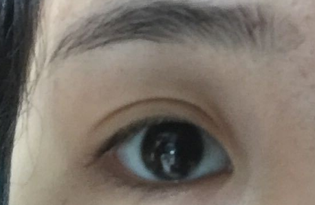 開內(nèi)眼角拆線后變化明顯嗎？