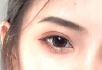 開(kāi)內(nèi)外眼角的恢復(fù)期是多久？術(shù)后后遺癥有哪些？