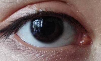 開眼角幾天能恢復(fù)？