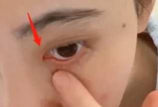 開內(nèi)眼角對(duì)眼睛有傷害嗎？
