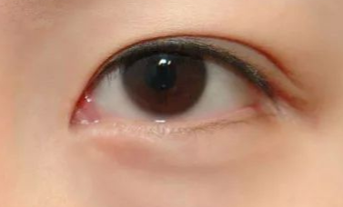 開內(nèi)眼角的優(yōu)缺點(diǎn)有哪些？