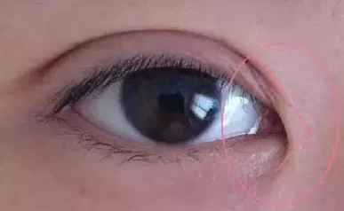 開內(nèi)眼角的作用有哪些？開內(nèi)眼角都會回縮嗎？