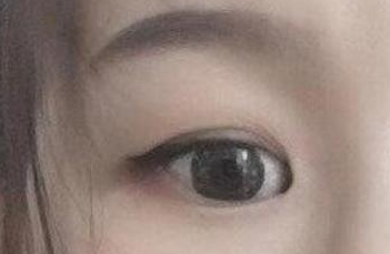 開內(nèi)眼角的手術(shù)費(fèi)用多少？