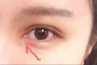 開眼角割雙眼皮拆線嗎？術(shù)后拆線疼嗎？