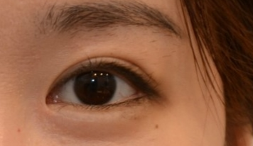 開眼角有效果嗎？開眼角有哪些危害？