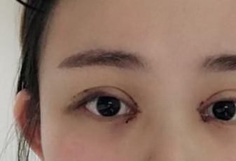 開眼角后多長時(shí)間能恢復(fù)？