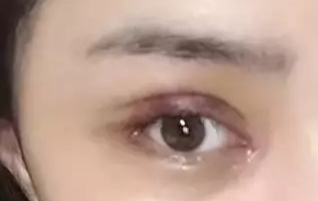 開眼角一般要恢復多久？
