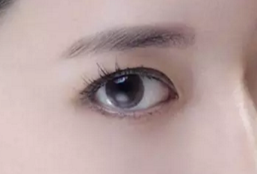 開眼角術后多久才能恢復？開眼角術后防止疤痕增生怎么做？