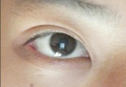 開眼角手術后會影響視力嗎？開眼角手術費用貴嗎？