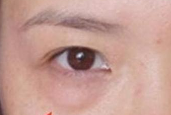 光纖溶脂去眼袋手術(shù)有哪些優(yōu)勢(shì)？