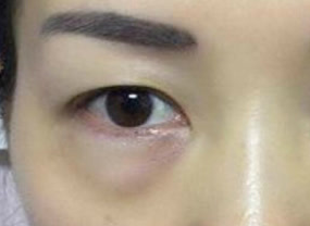 光纖溶脂去眼袋術(shù)后如何護(hù)理？
