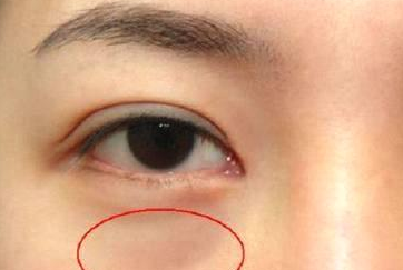 光纖溶脂祛眼袋需要多少錢？光纖溶脂怎么樣呢？
