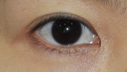 開(kāi)眼角需要多長(zhǎng)時(shí)間恢復(fù)？術(shù)后眼角發(fā)紅怎么辦？