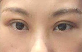 激光去眼袋能維持多長時(shí)間？祛眼袋的手術(shù)效果好嗎？