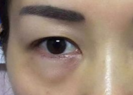 激光可以祛眼袋嗎？激光祛眼袋有哪些副作用？